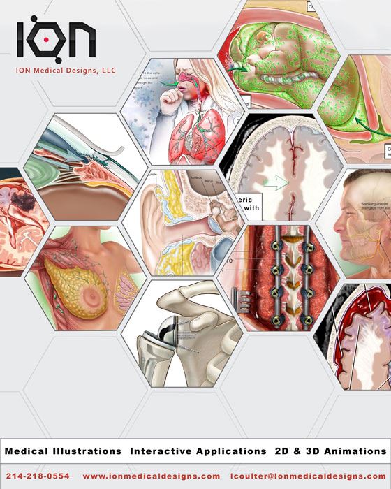 ION Medical Designs, LLC, ION Medical Designs, LLC, Medical Illustrations, Interactive Applications, 2D & 3D Animations